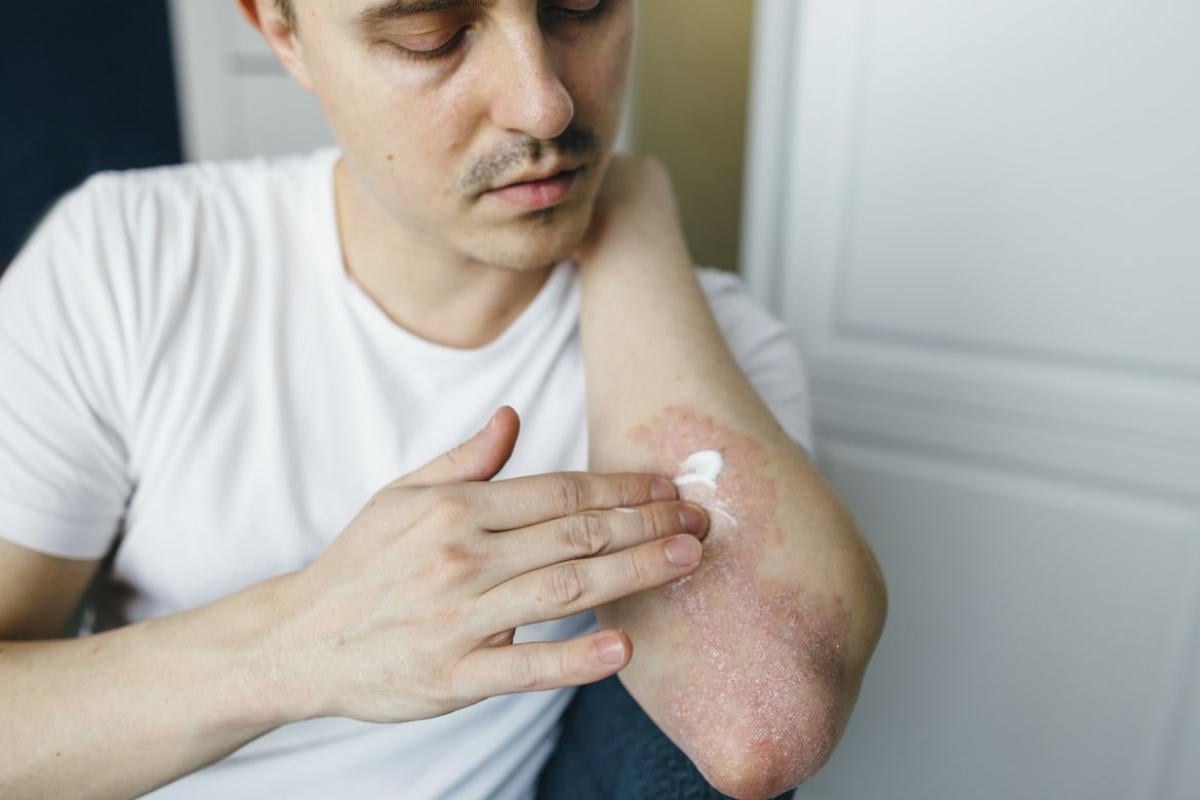 Person rubs lotion on a patch of eczema